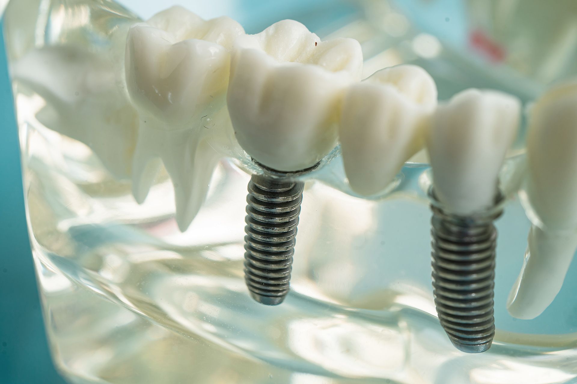Un modelo de un diente con dos implantes dentales.