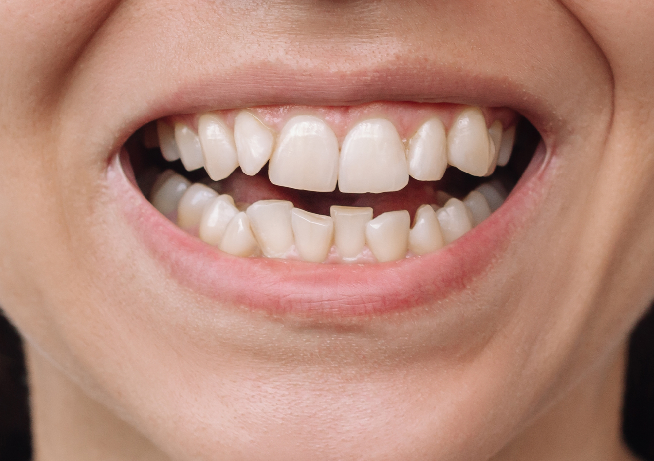 Un primer plano de los dientes de una mujer a la que le falta un diente.