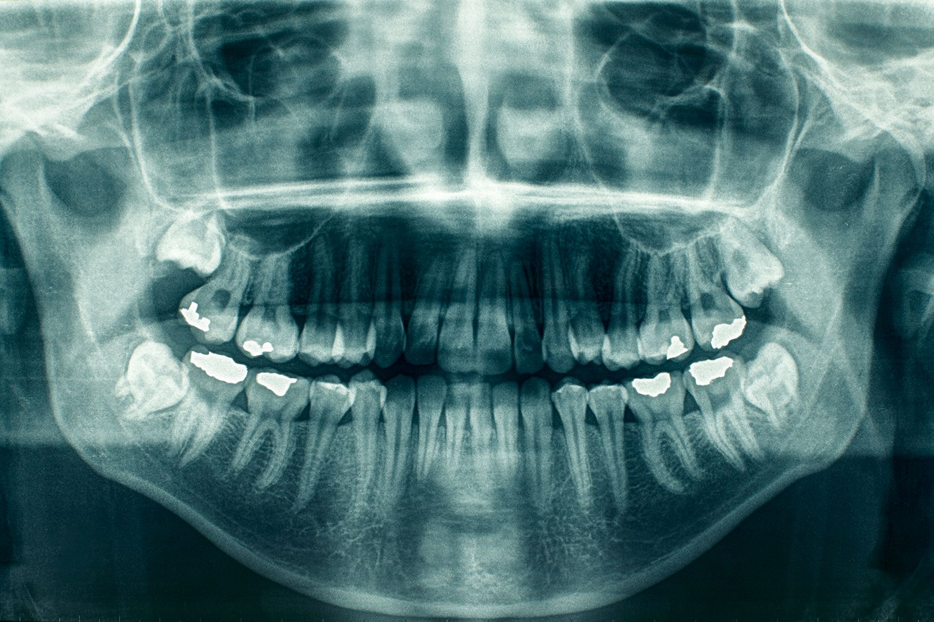 Una radiografía de los dientes y el cráneo de una persona.