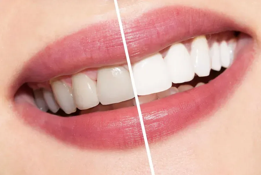 Woman Thinking About Teeth Whitening