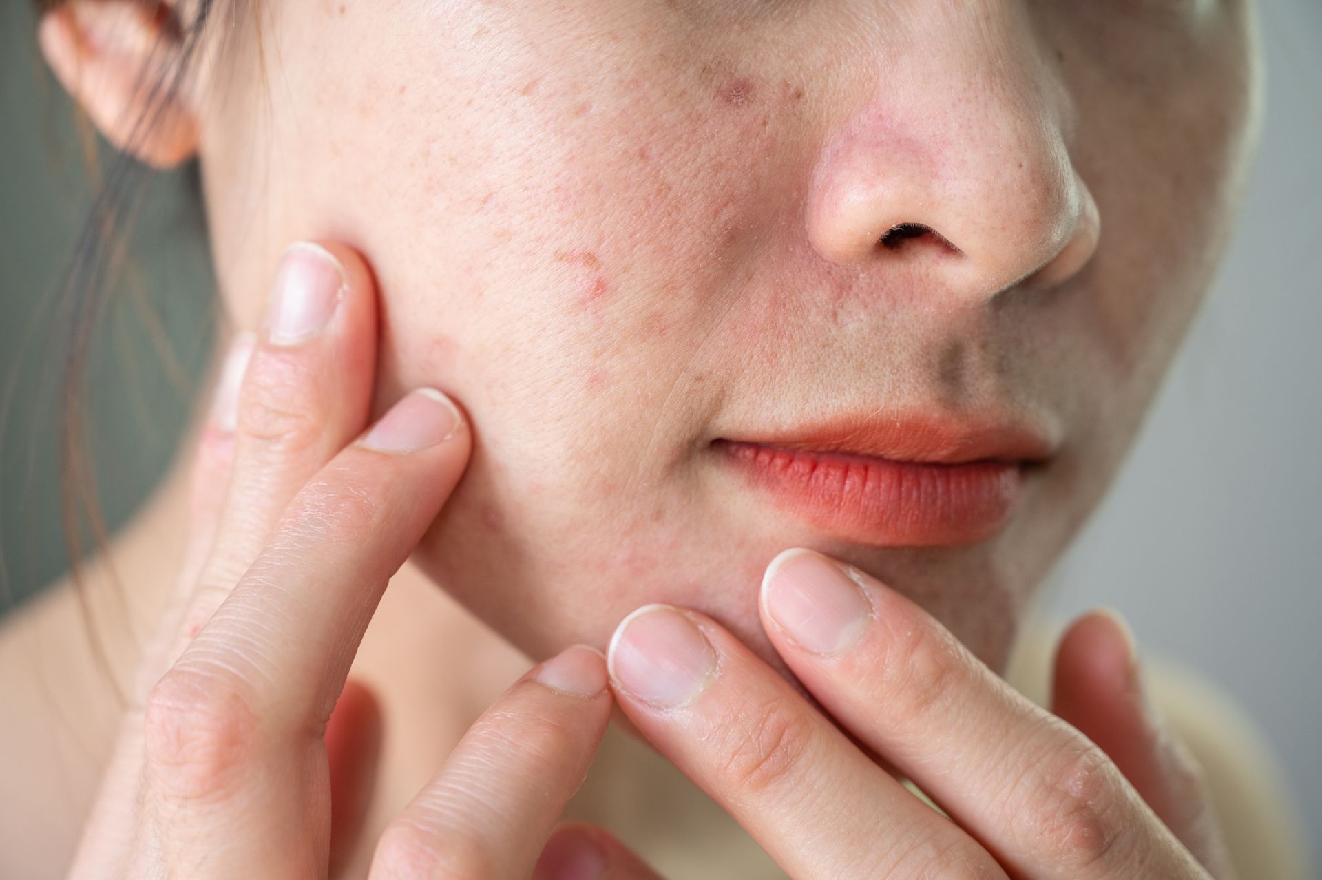 A woman with acne on her face is touching her face with her hands. A woman with acne on her face is touching her face with her hands.