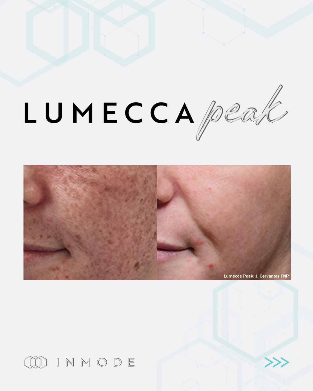 Lumecca Peak skincare ad showing before-and-after close-up cheek skin treatment results