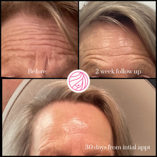 Forehead wrinkle progress collage: before, 2-week follow-up, and 30-day follow-up photos.