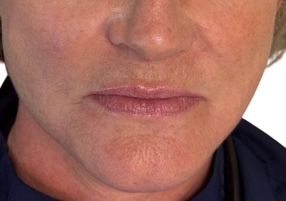Close-up of a person's lower face with lips and chin, wearing a dark collar.