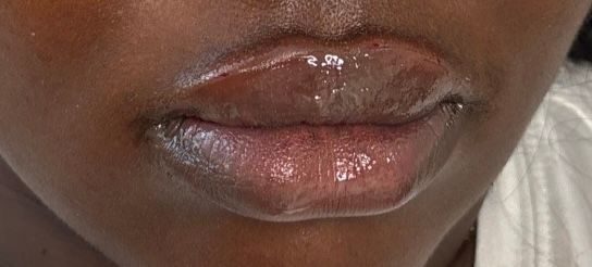 Close-up of a person’s lips with a glossy, slightly swollen appearance