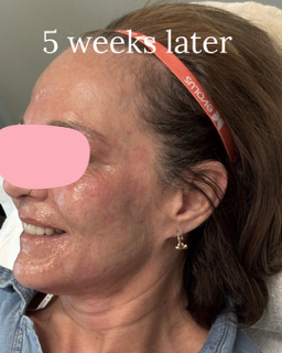 Profile view of a woman with facial redness and flaking skin, labeled “5 weeks later”