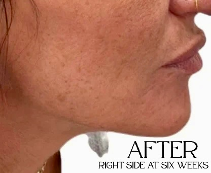 Side profile of a person's face with acne scars, labeled 