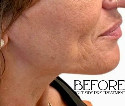 Close-up profile of a woman’s lower face and neck labeled “BEFORE” in a side-by-side treatment photo.