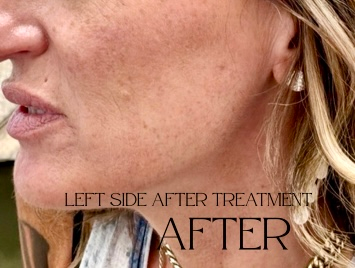 Close-up side profile after treatment, showing smoother skin and subtle facial texture changes.