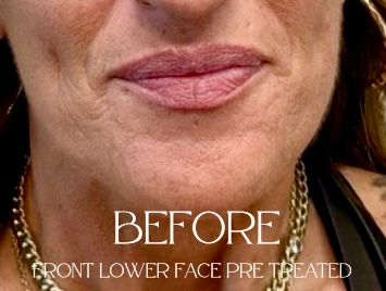 Close-up of lower face with “BEFORE” and “front lower face pre treated” text overlay