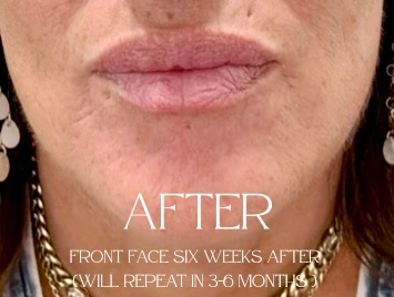Close-up of lips and lower face with overlaid text: “AFTER,” “FRONT FACE SIX WEEKS AFTER,” and “WILL REPEAT IN 3-6 MONTHS”