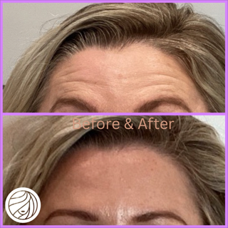 Before-and-after close-up of a forehead showing reduced wrinkles after treatment