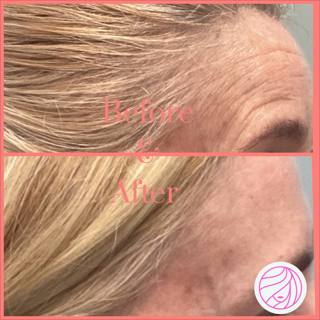 Before-and-after close-up of a forehead and hairline, showing smoother skin after treatment.