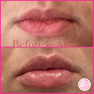 Before-and-after close-up of lips, showing a pinker, glossier result after treatment