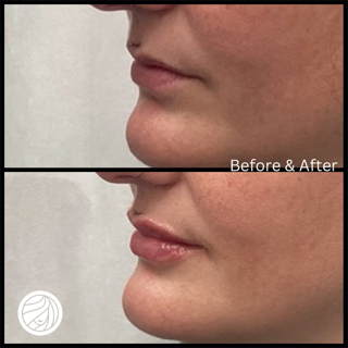 Side-by-side close-up of a person’s lower face labeled before and after, showing fuller lips in the after image.