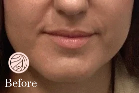 Close-up of a woman’s lower face and lips with the word “Before” in the corner.