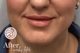 Close-up of a person’s lower face with a “After 2 weeks later” label and logo in the corner.