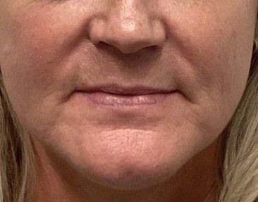 Close-up of a person’s lower face with neutral expression and light makeup.