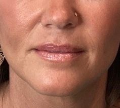 Close-up of a person's lower face with neutral expression and closed lips.