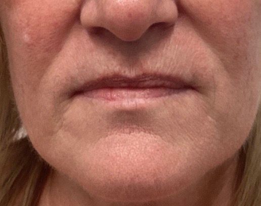 Close-up of a neutral mouth and lower face with natural skin tone.