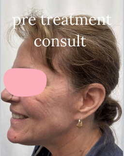 Side-profile of a woman with “pre treatment consult” text overlay, pink-marked eyes