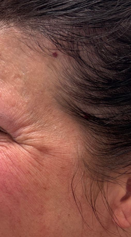 Close-up of a person’s temple with forehead wrinkles and dark hair pulled back