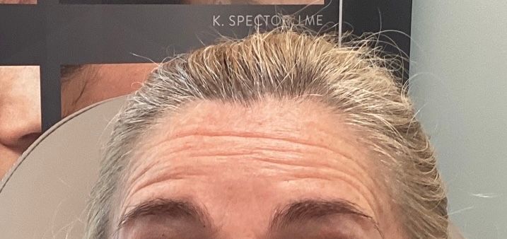 Close-up of a person’s forehead and hairline in front of an eye chart