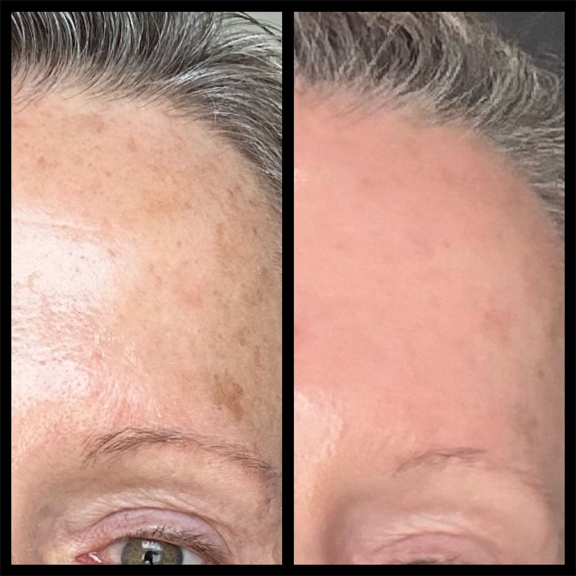 Close-up before-and-after of a forehead with reduced wrinkles and redness after treatment