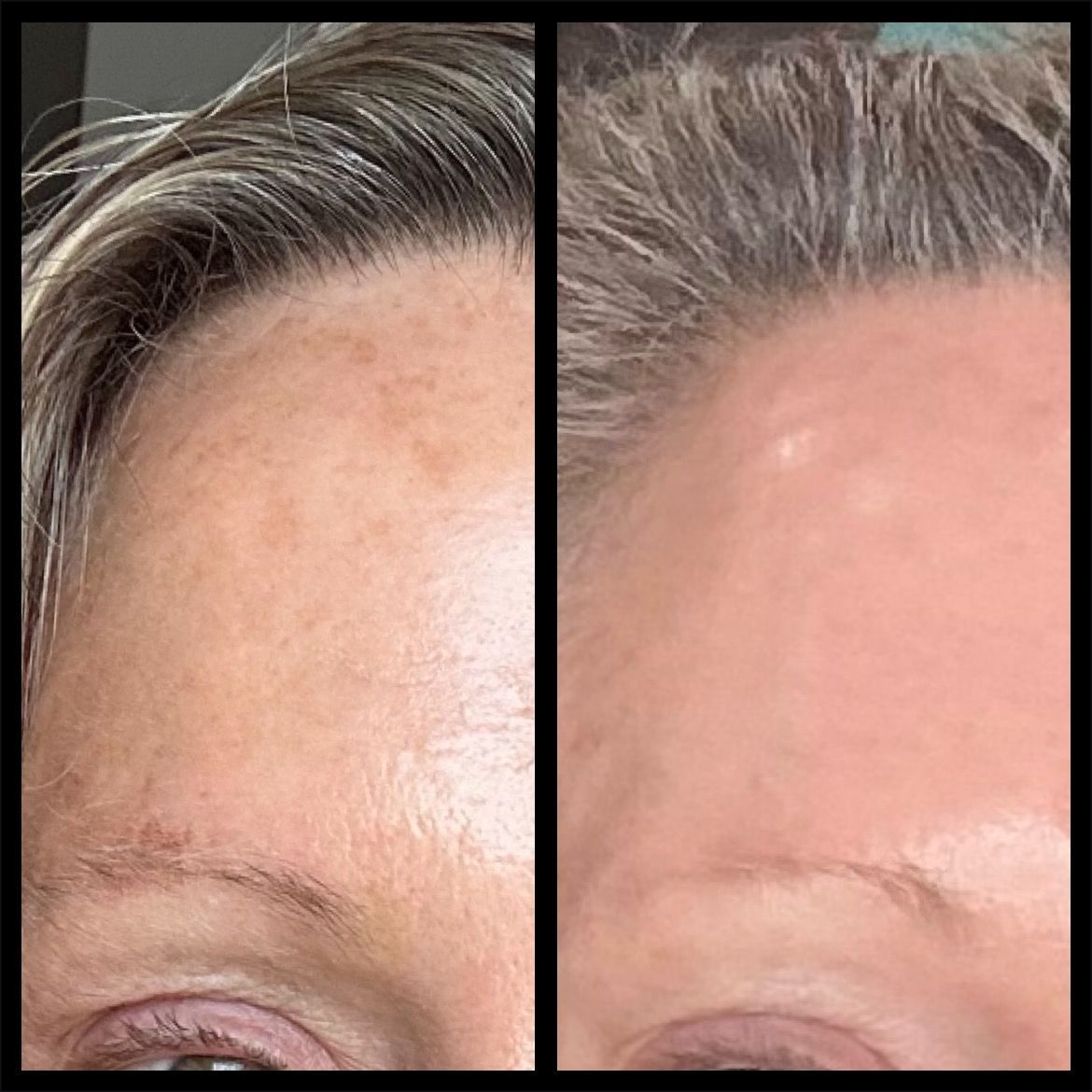 Side-by-side close-up of a forehead before and after treatment, with smoother, clearer skin on the right