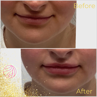 Split before-and-after close-up of lips, showing fuller, more defined lips after treatment.