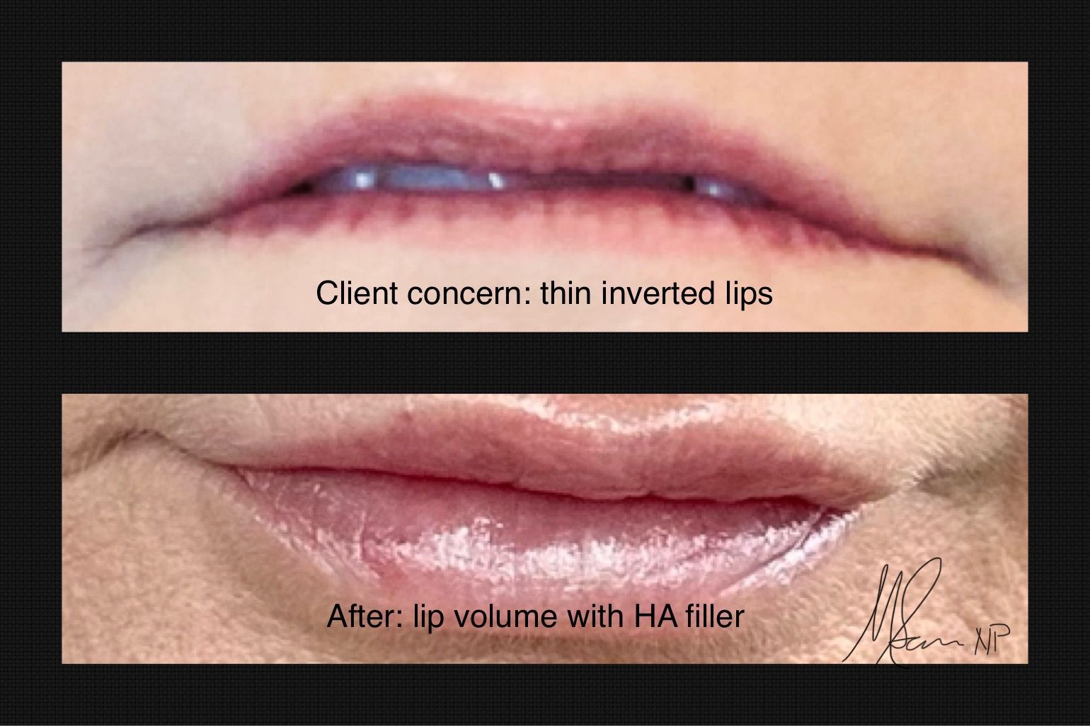 Before-and-after close-up of lips, showing thin inverted lips and fuller lips after HA filler treatment.