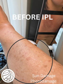 Close-up of sun-damaged skin on a forearm labeled “Before IPL”
