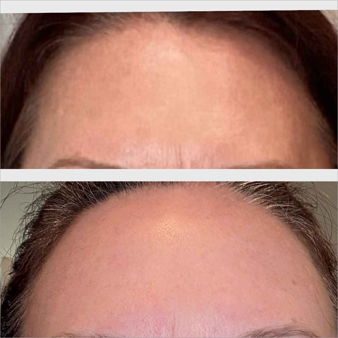 Forehead before and after treatment, showing reduced wrinkles and smoother skin