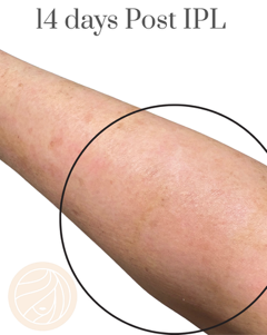 Forearm skin with mild redness, circled and labeled “14 days Post IPL”