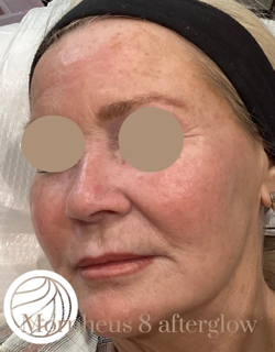 Close-up of a face with visible skin redness, photographed in soft lighting.