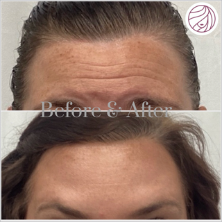 Before-and-after close-up of a forehead and hairline, showing reduced wrinkles and fuller hair.