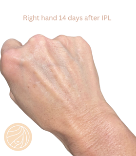 Close-up of a right hand 14 days after IPL, showing mild skin redness and texture.