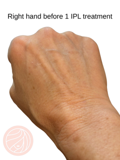 Back of right hand before IPL treatment, with visible veins and mild skin discoloration