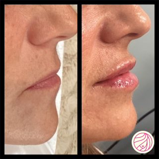Side-by-side close-up of lips and nose, showing before and after lip enhancement with fuller, glossier lips.