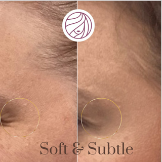Close-up of a cheek with visible pore, split into before and after soft subtle skin treatment views