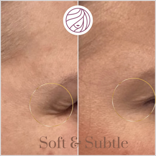 Side-by-side close-up of skin with a small dimple or indentation circled in each view