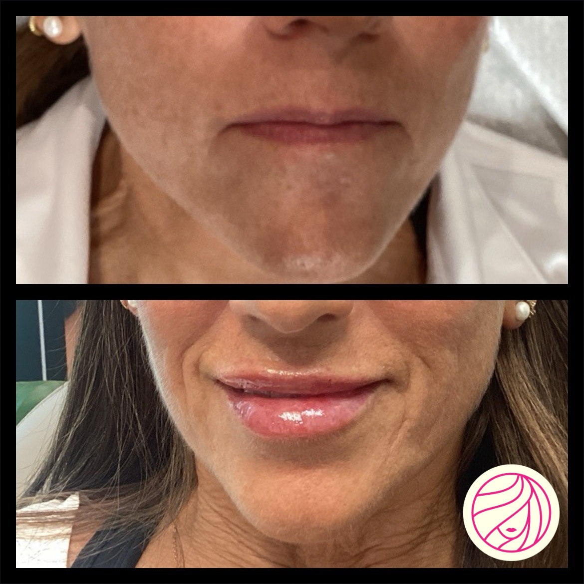 Close-up before-and-after of lips and chin, showing smoother, glossier lips in the lower photo.
