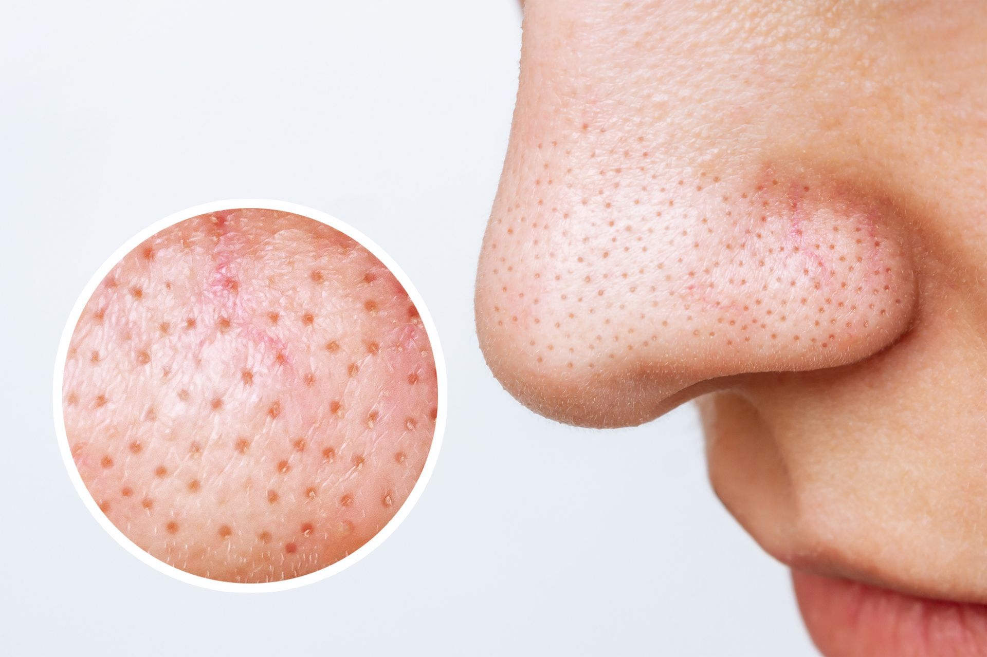 Close-up of a nose with visible blackheads, shown with a magnified inset of pores