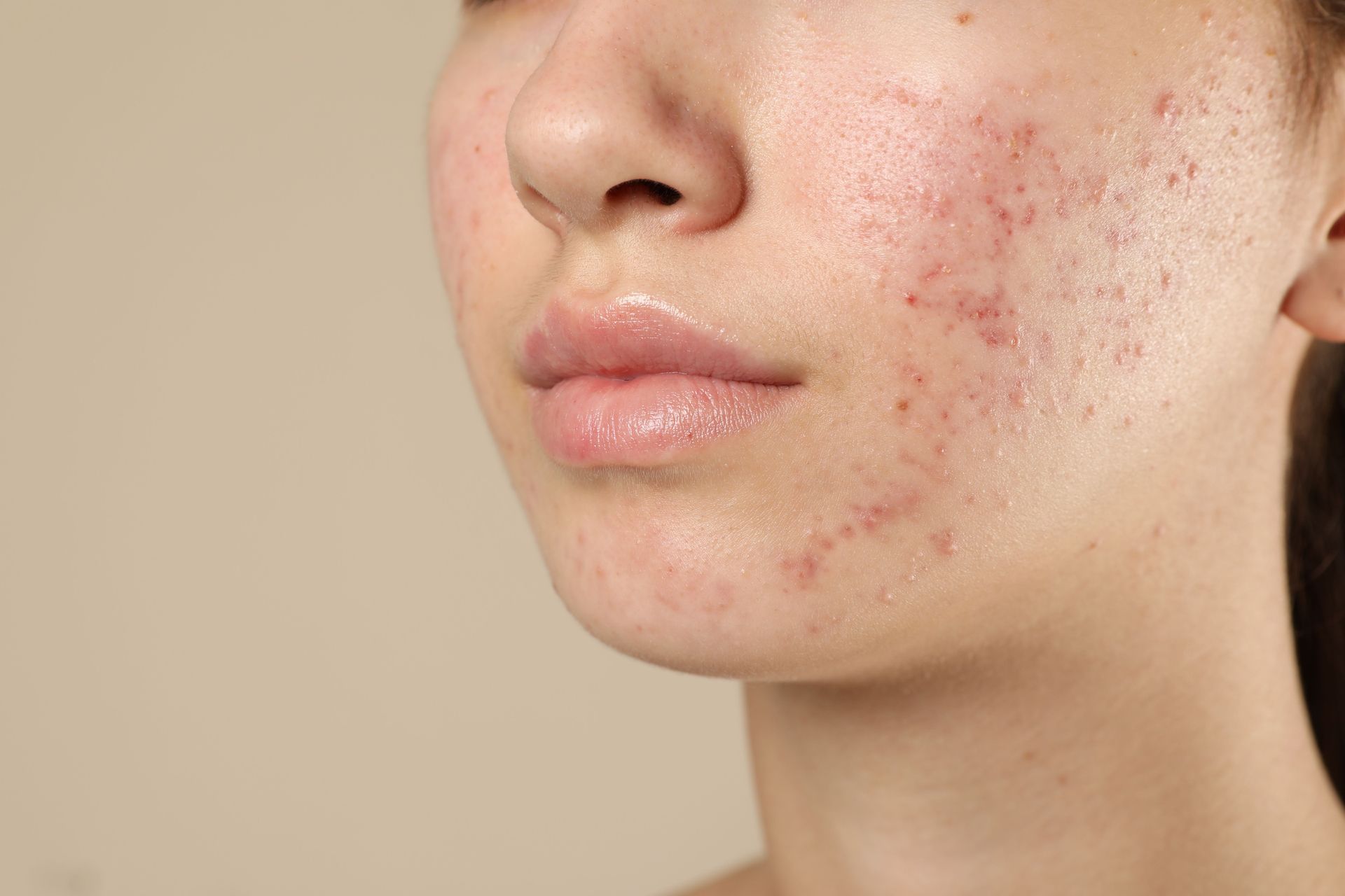 Close-up of a face with red acne blemishes on the cheek and jawline