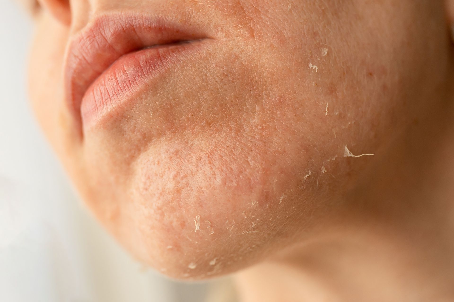 Close-up of a person’s chin and lower face with dry, flaky skin peeling.