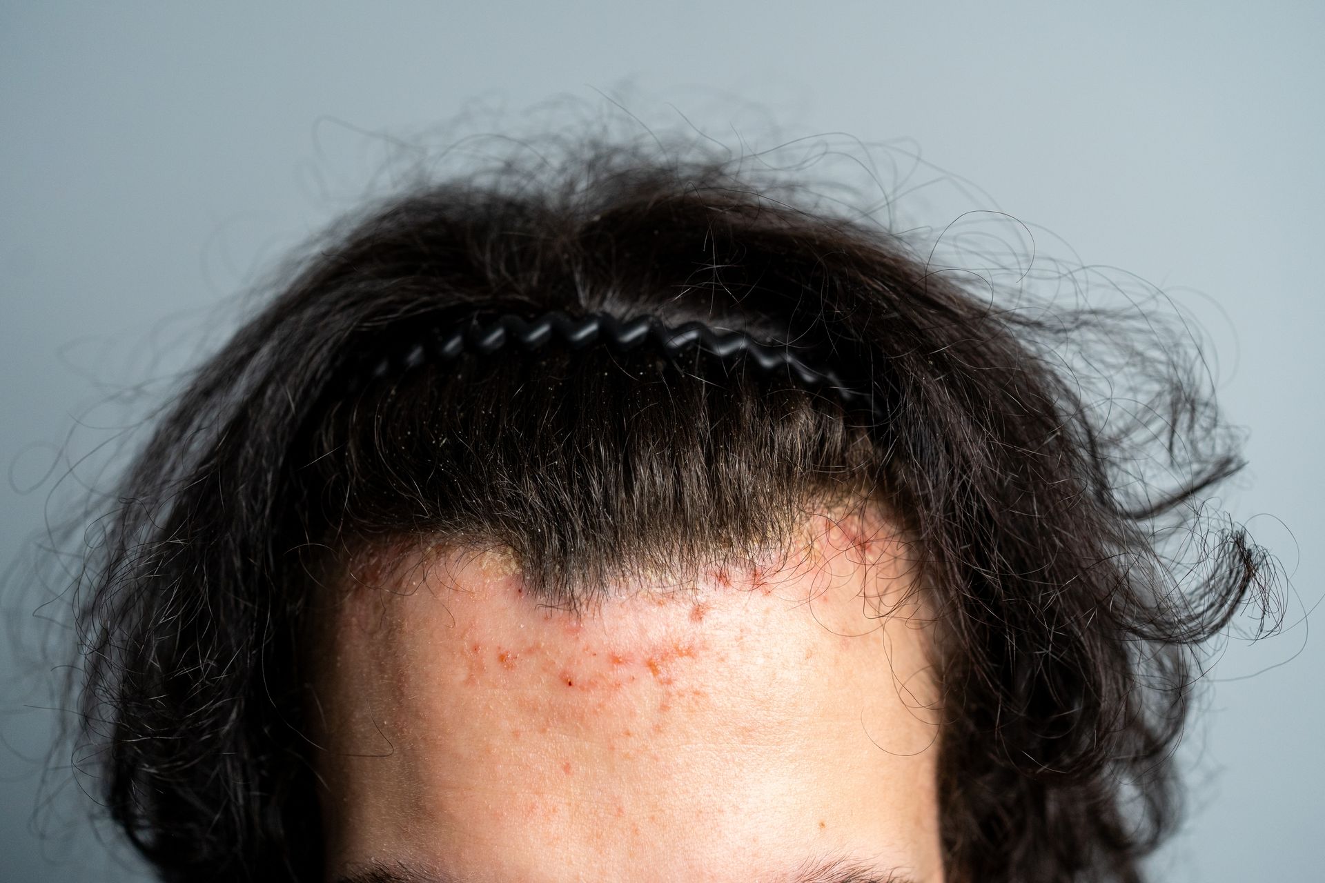 Close-up of a person's hairline with dark hair and visible redness on the forehead and scalp.