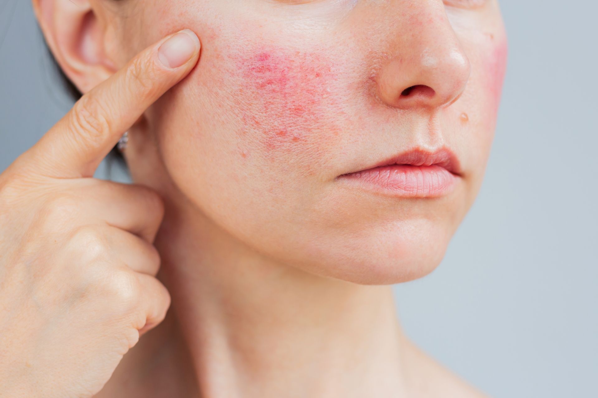 Finger pointing to a red, irritated cheek on a face close-up