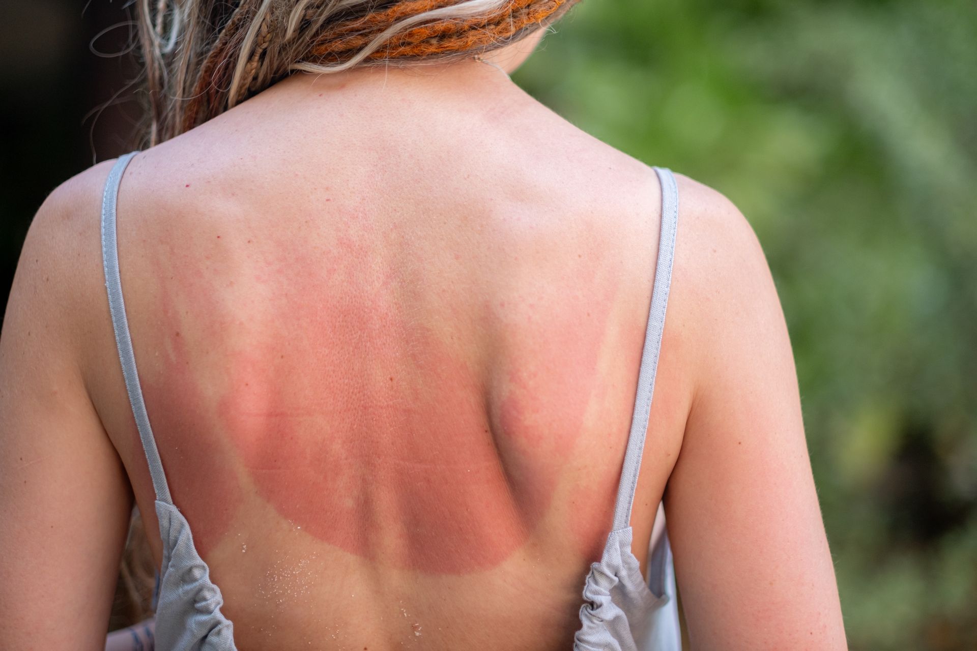 Person’s back with a large red sunburn on the shoulder blades, wearing a thin-strapped top.