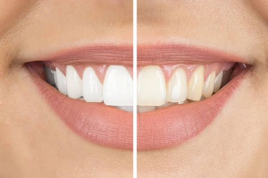 Split image of a smiling mouth showing whiter teeth on the left and yellower teeth on the right