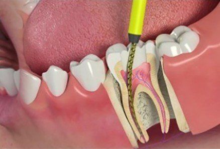 Tooth root canal being cleaned with a dental drill in a gum illustration